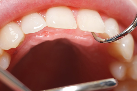 歯石、歯垢のたまった歯