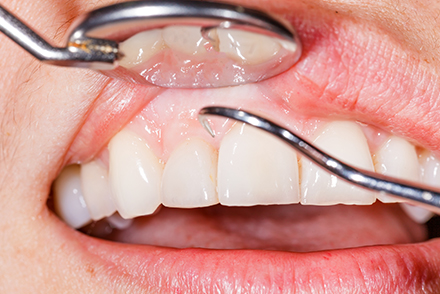 歯周組織検査表